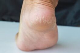 Dead skin below the foot