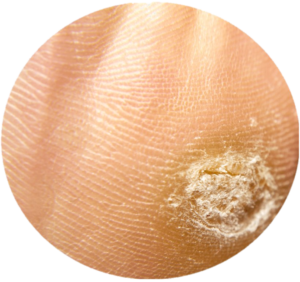 Illustration comparing a callus and corn, highlighting their distinct characteristics - a flat, spread-out callus versus a more localized, cone-shaped corn