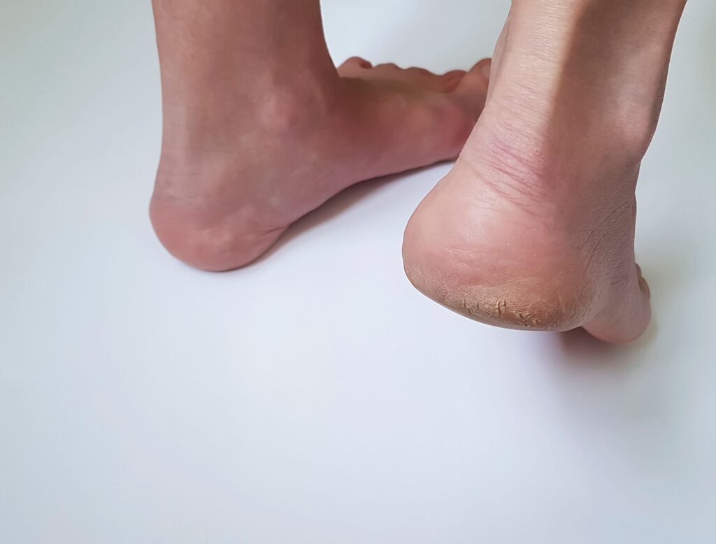 Bare Feet