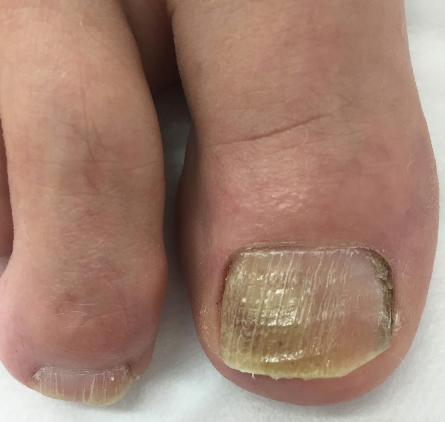 Fungal toenail