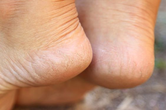 Bare Feet
