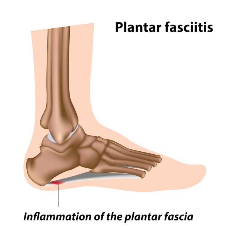 Illustrative diagram depicting the foot skeleton and key areas affected by Plantar Fasciitis, highlighting the factors and causes contributing to the condition.