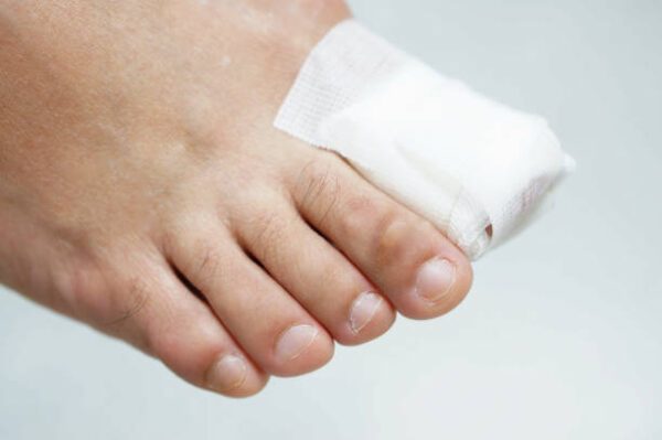 Bare Feet while one of the toes injured 