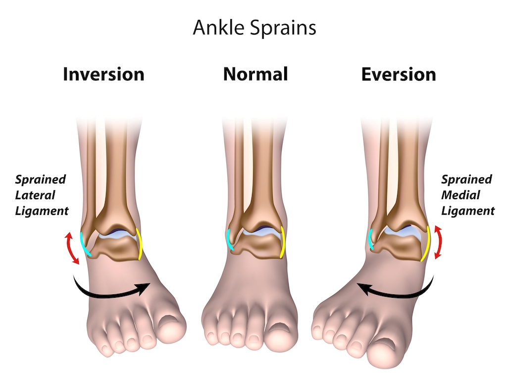patient's foot diagram about patient's foot diagram about Ankle Sprains