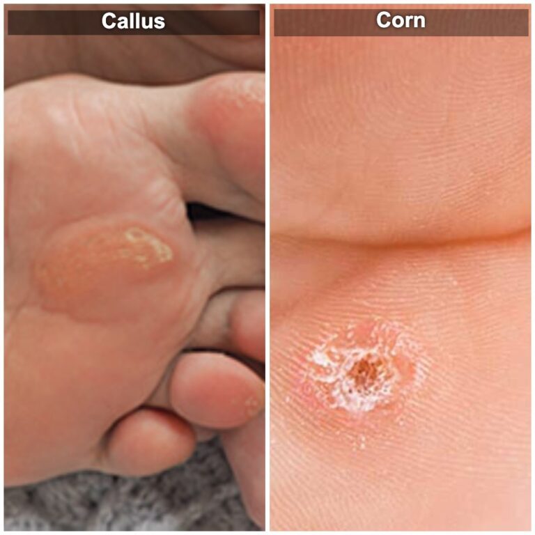 Illustration comparing a callus and corn, highlighting their distinct characteristics - a flat, spread-out callus versus a more localized, cone-shaped corn