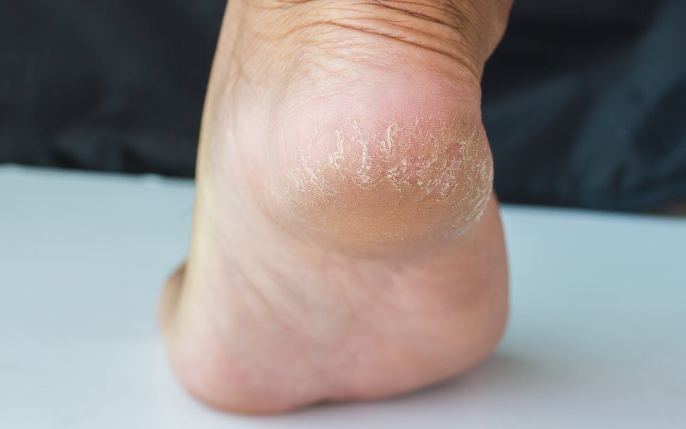 dead skin under the feet
