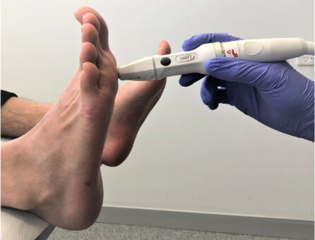 Healing foot by Swift device in VERRUCAS TREATMENT