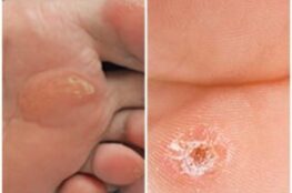 Corns & Calluses below the patient's foot